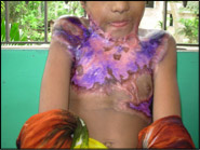 Petite fille de 9 ans Shopira qui a subi des br&ucirc;lures multiples au niveau du cou et de la poitrine